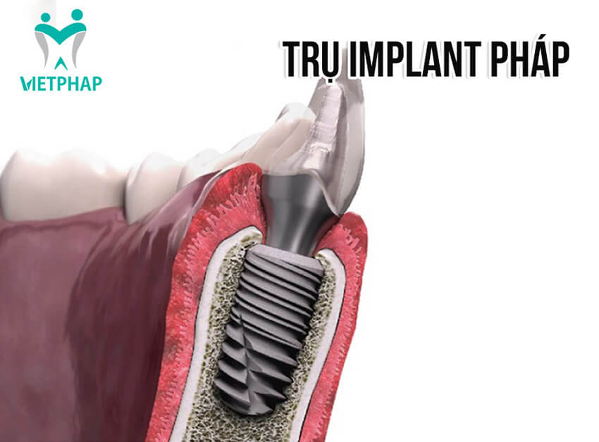 tru-implant-phap