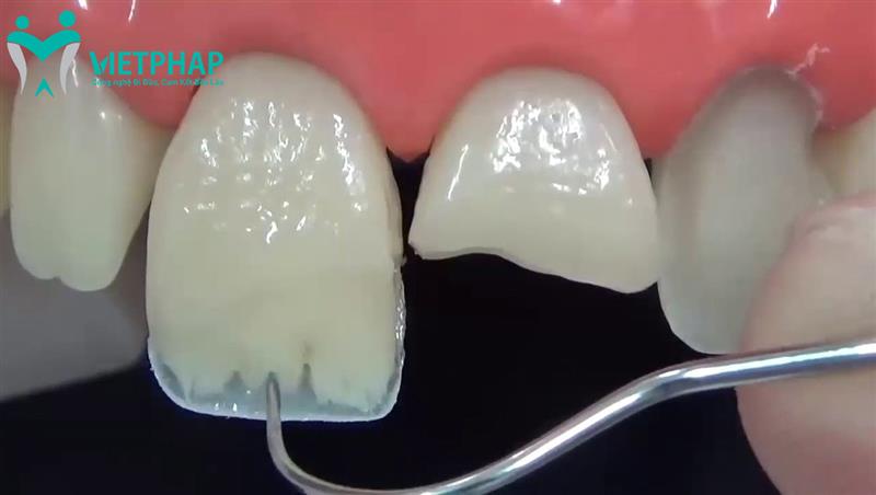 Trường hợp nào nên trám răng cửa? Quy trình trám răng cửa bị mẻ chuẩn y khoa