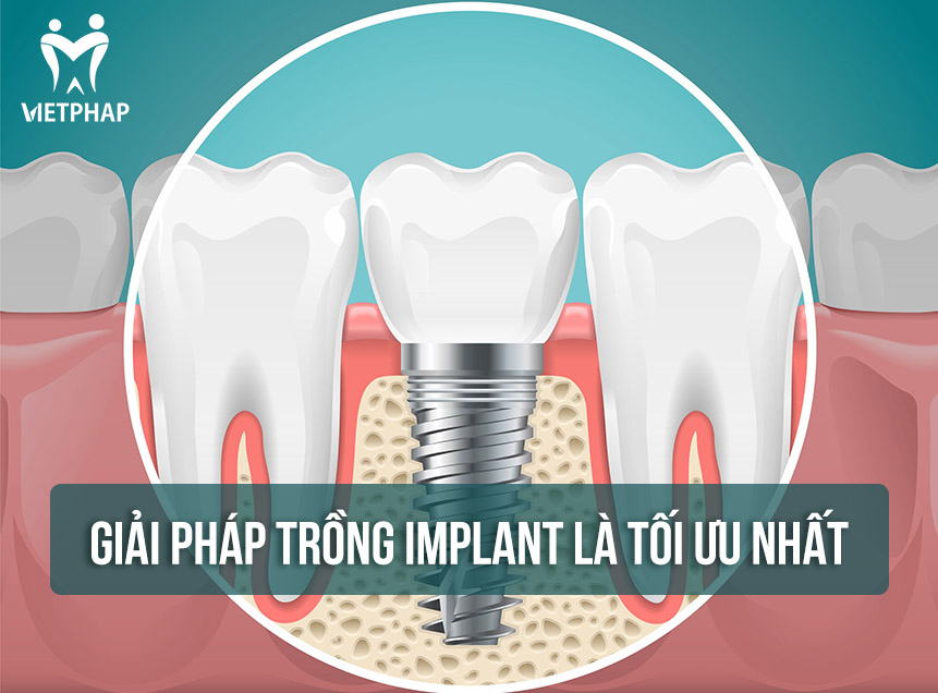 Giải pháp trồng răng/ cấp ghép răng bằng Implant hiện đang là tối ưu nhất