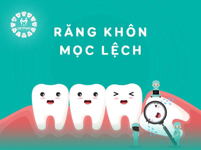 rang-khon-moc-lech
