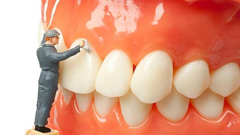 Lấy cao răng siêu âm – sự lựa chọn hàng đầu của các nha sĩ