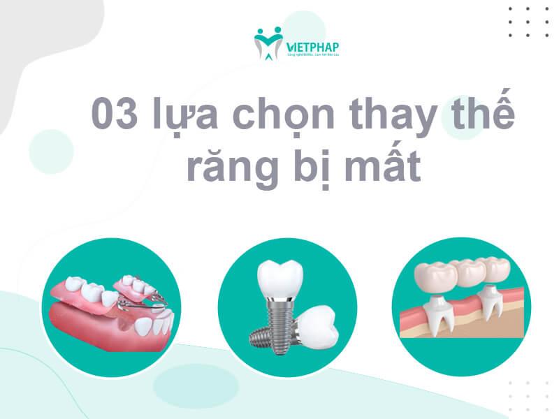Top 3 cách lựa chọn để thay thế răng bị mất từ chuyên gia