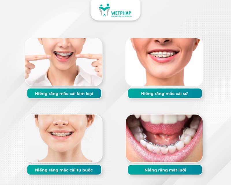 So sánh các phương pháp niềng răng phổ biến nhất hiện nay