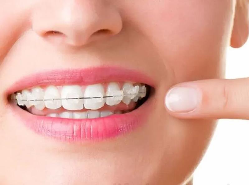 Niềng răng một hàm là như thế nào ? Trường hợp nào làm được và có hiệu quả không ?
