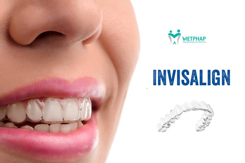 Quy trình niềng răng Invisalign được thực hiện như thế nào?