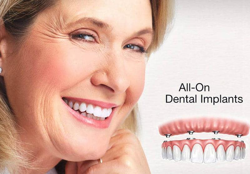 Trồng răng Implant nguyên hàm là gì? Áp dụng cho trường hợp nào?