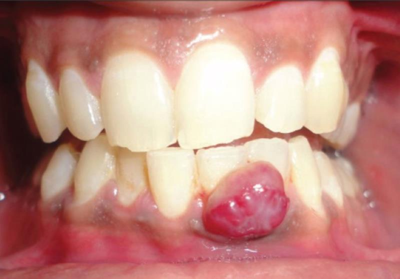 Viêm chân răng có mủ – Triệu chứng không thể coi thường