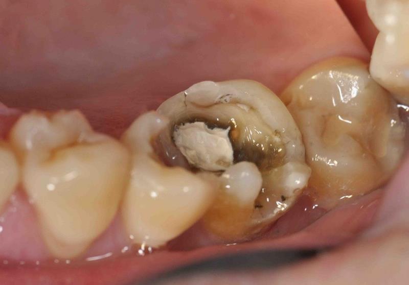 Răng hàm bị sâu – Khi nào phải nhổ?