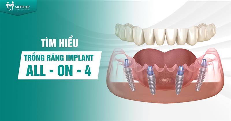 Tìm hiểu chi tiết phương pháp trồng răng Implant All on 4
