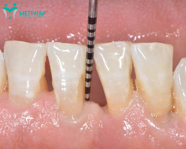 Khám phá quy trình hàn cổ răng bị mòn chuẩn y khoa 2022