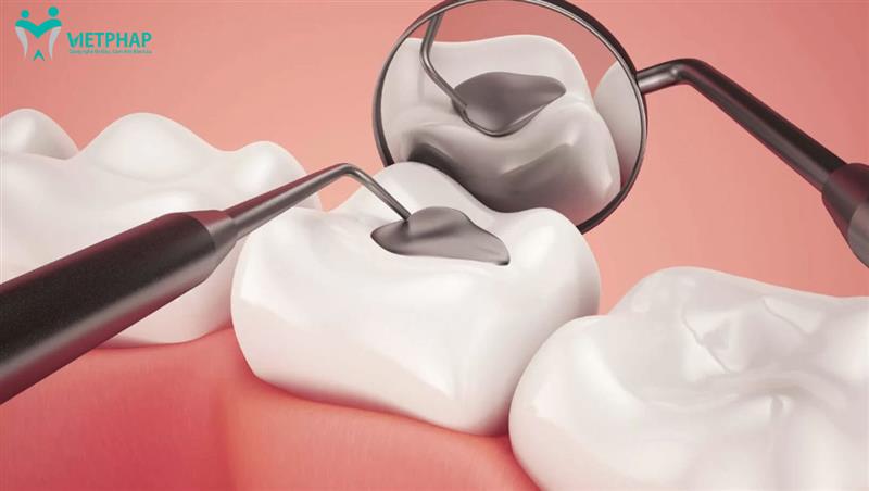 Hàn răng có đau không? Nguyên nhân khiến hàn răng bị đau