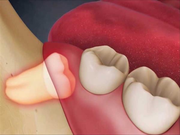Nhổ răng số 8 an toàn không đau nhức