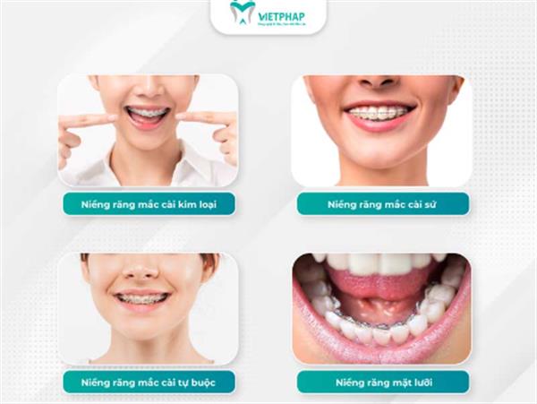 So sánh các phương pháp niềng răng phổ biến nhất hiện nay