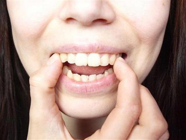 Niềng răng tại nhà có tốt không? Nguy hiểm luôn rình rập bạn