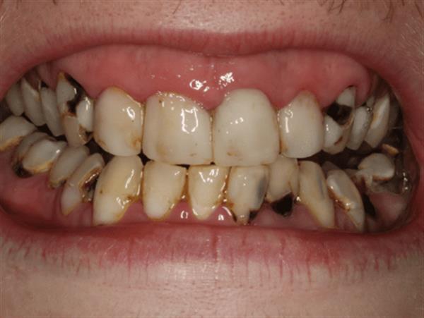 Đang bị sâu răng có niềng răng được không? Nên chọn loại niềng răng nào?