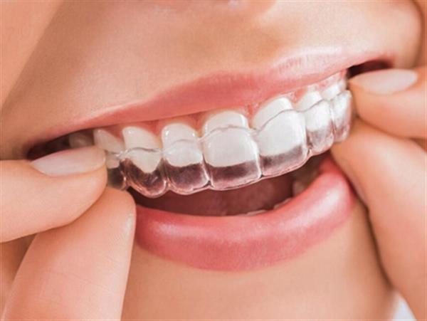 Niềng răng invisalign có tốt không? Có nên niềng răng Invisalign?