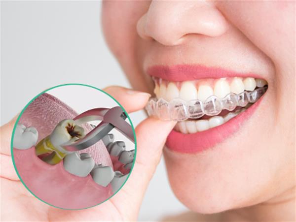 Niềng răng Invisalign có cần nhổ răng không?