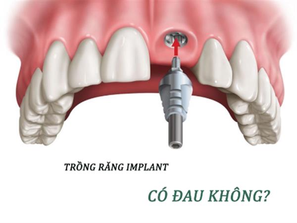 Trồng răng Implant có đau không? Cách làm giảm đau khi cấy Implant