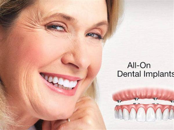Trồng răng Implant nguyên hàm là gì? Áp dụng cho trường hợp nào?