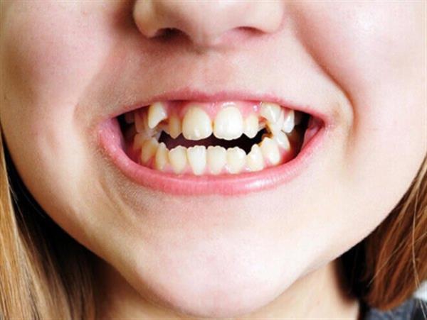Muốn nhổ răng khểnh an toàn cần chú ý điều gì?