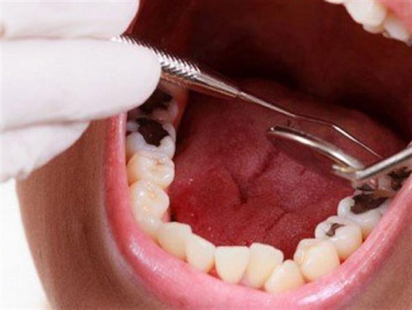 Quy trình hàn răng sâu “chuẩn” diễn ra như thế nào?