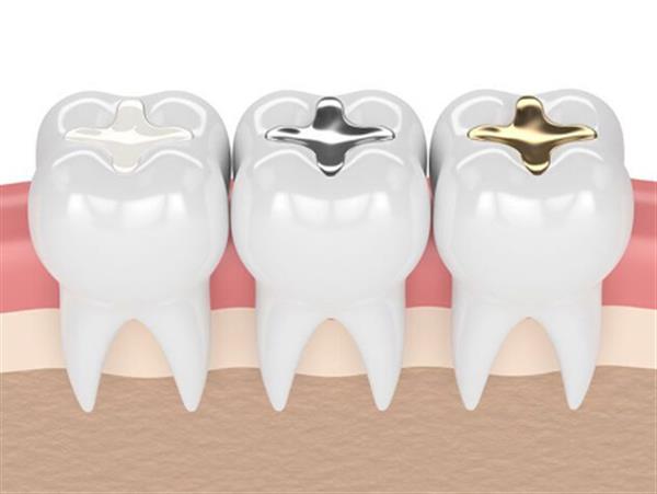 6 lưu ý quan trọng cần nhớ sau khi hàn răng