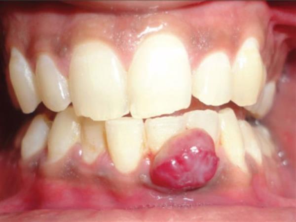 Viêm chân răng có mủ – Triệu chứng không thể coi thường