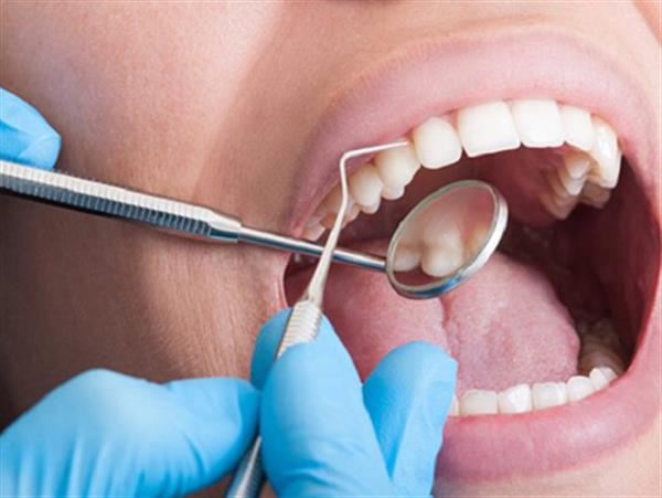 Lấy cao răng có giải quyết được tình trạng hôi miệng không?