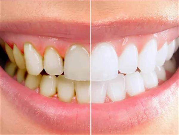 Nha sĩ giải đáp: Lấy cao răng có làm trắng răng không?