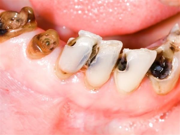 Hiểu đúng về sâu răng và điều trị răng sâu