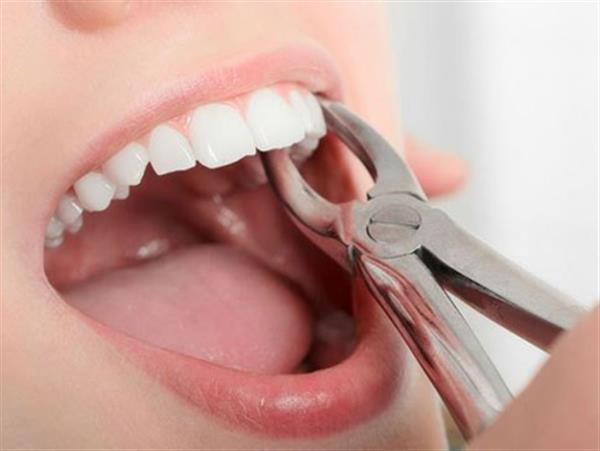 Nhổ răng cửa được chỉ định trong những trường hợp nào?