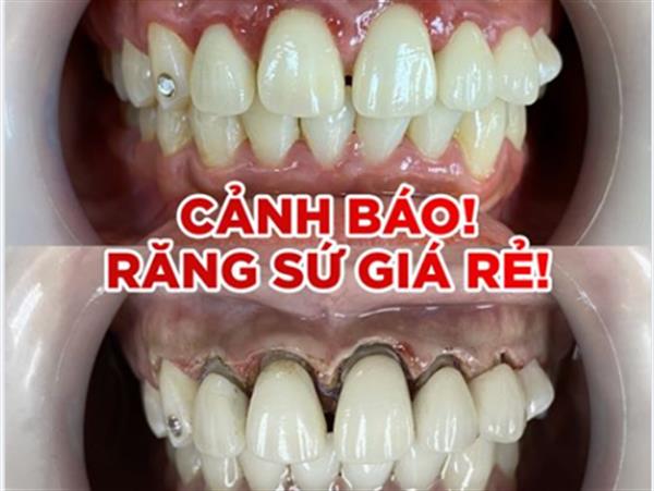 5 hậu quả tai hại khi làm răng sứ thẩm mỹ giá rẻ