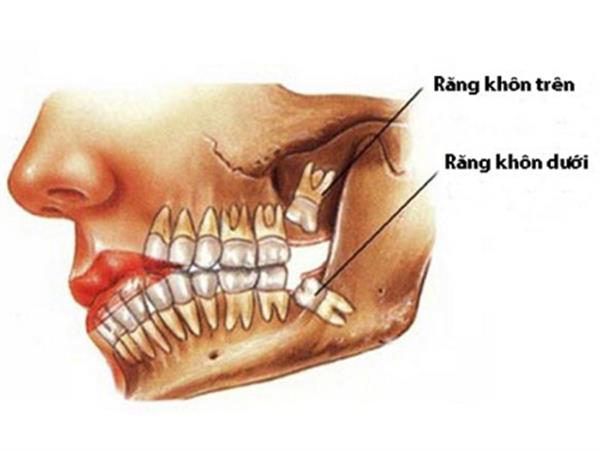 Nhổ răng số 8 An toàn không đau