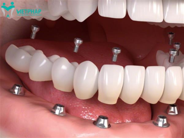 Tìm hiểu chi tiết phương pháp trồng răng Implant All on 6