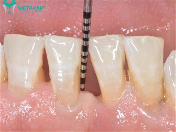 Khám phá quy trình hàn cổ răng bị mòn chuẩn y khoa 2022