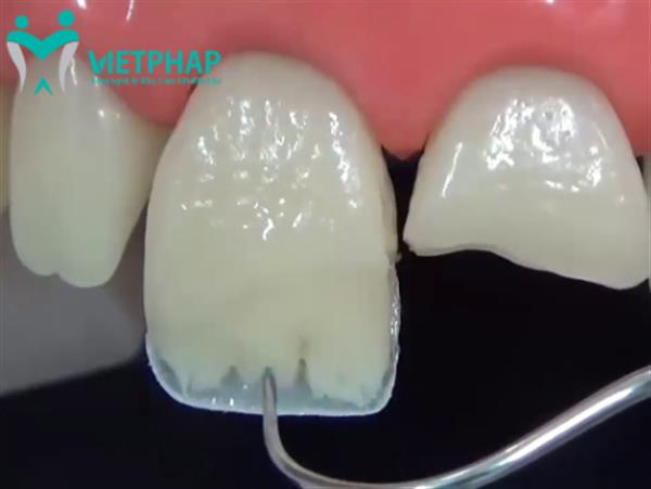 Trường hợp nào nên trám răng cửa? Quy trình trám răng cửa bị mẻ chuẩn y khoa